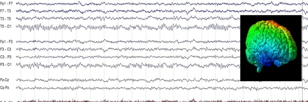 EEG definicja i krótka historia > EEG Elektroencefalografia